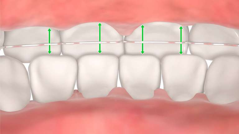 Optimaler Sitz Retainer