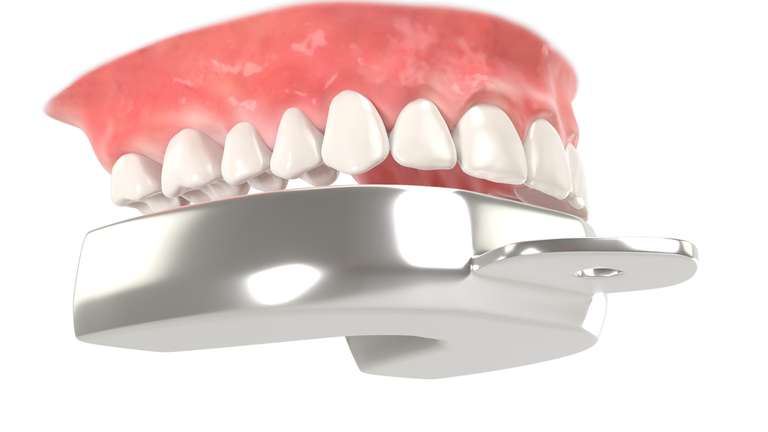 Abformlöffel Oberkiefer