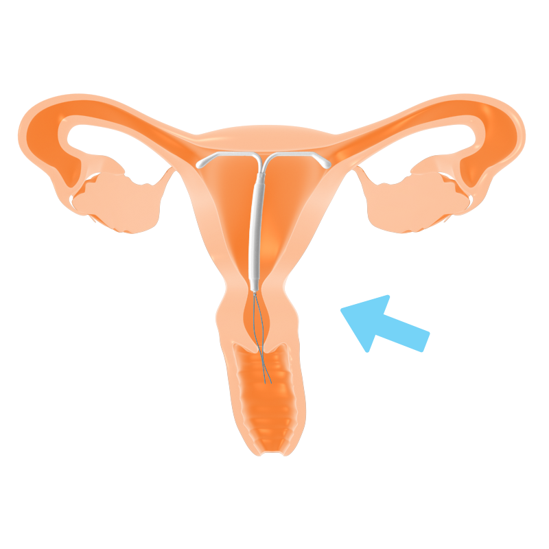Spirale Uterus 